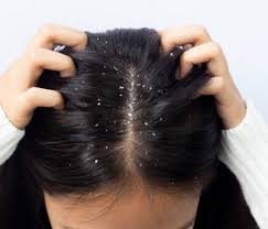 Dandruff Treatment